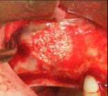 greffe ossseuse sous-sinusienne